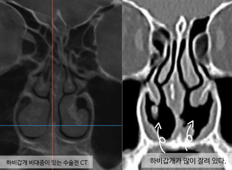 빈코증후군이란 — 정말 하비갑개 수술을 겁내야 할까