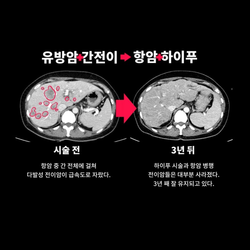 유방암4기, 간전이 하이푸 3년 경과