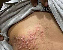 수포 없는 대상포진 가능할까? 얼굴 통증 증상부터 보험 진단금 청구 팁까지