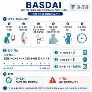 강직성 척추염 운동, ‘스트레칭’만으로 설명할 수 없는 이유