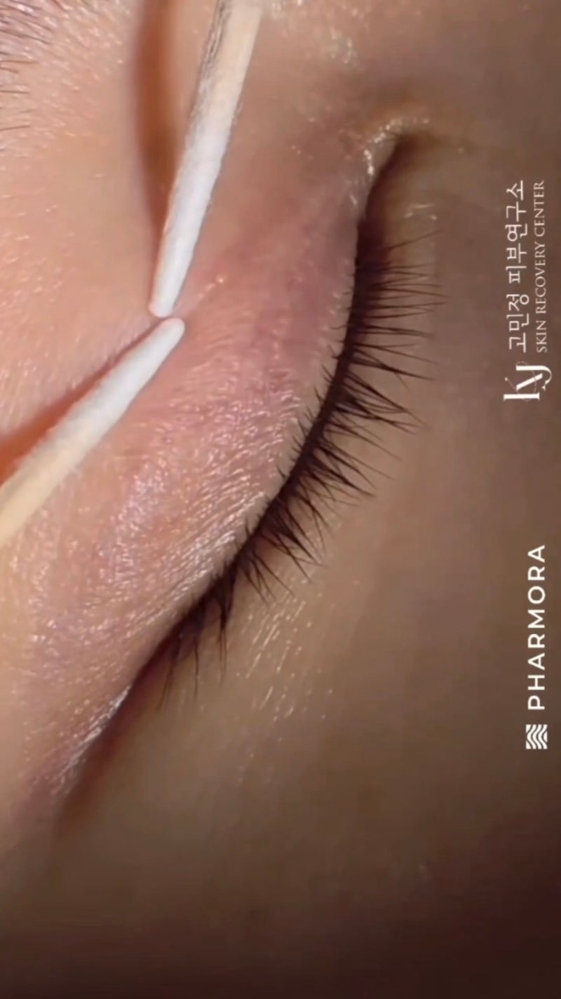 광주비립종관리 파모라센터 고민정피부연구소