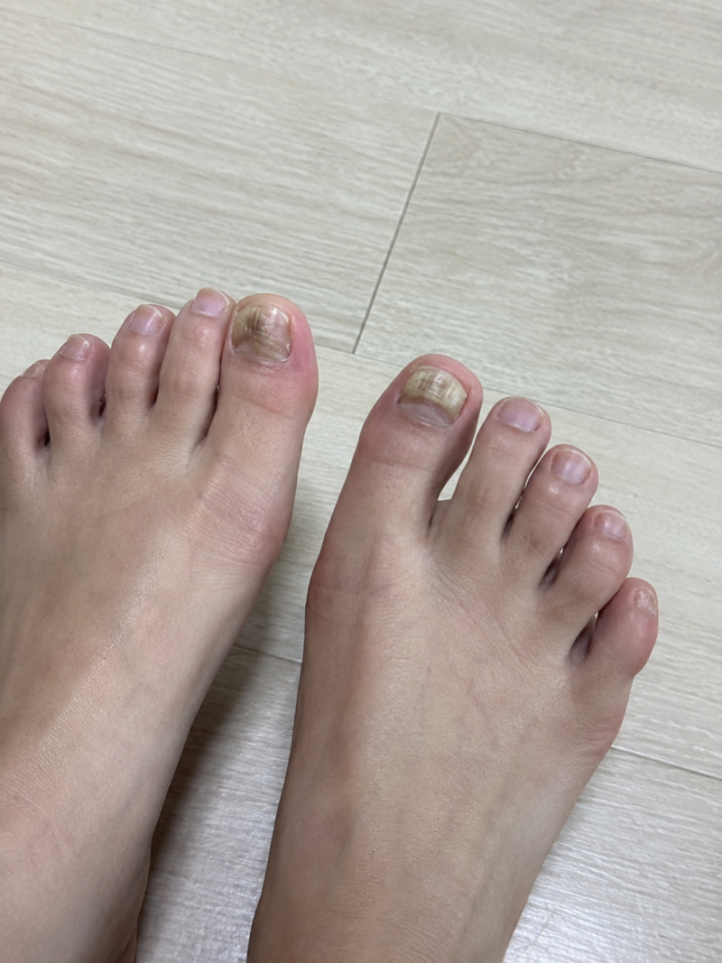 주블리아 가격 사용방법 발톱 1달 사용 후기