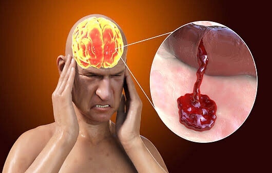 뇌출혈 전조증상, 사실 대부분 없어요 | 질병관리청 조기증상 5가지와 '하지 마세요' 4가지·....
