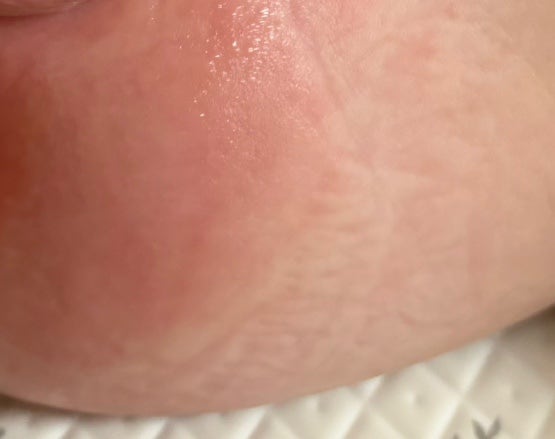 아기 기저귀 발진 파우더 발라도 될까? 직접 써본 엉덩이발진 관리 후기