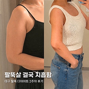 대구 팔뚝 다이어트 결국 반월당에서 지방흡입한 후기 1탄