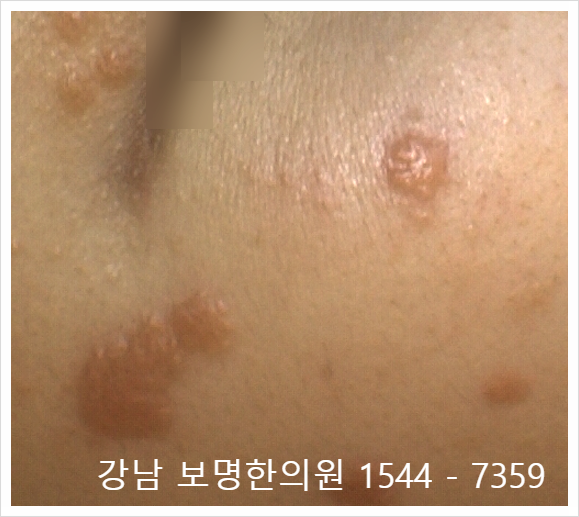 얼굴 편평사마귀 제거 후 재발되는 원인 어떻게 될까요?