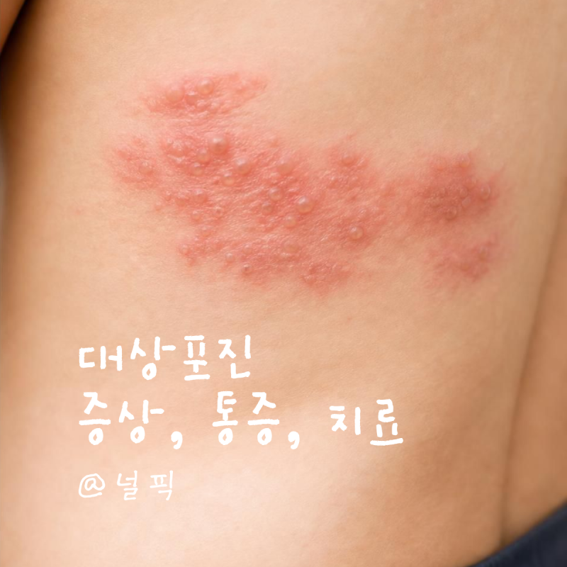 몸살인 줄 알았는데 대상포진 증상이었어요 통증, 치료, 발진, 물집 관리