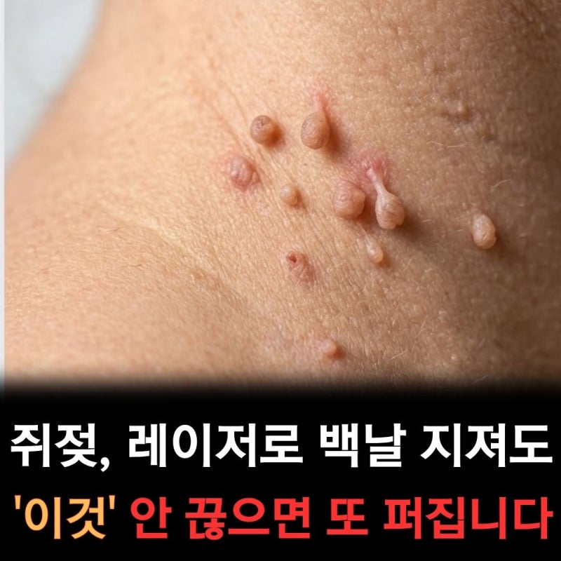 피부과 쥐젖제거비용 평균은? 목에 쥐젖 생기는 이유, 연고