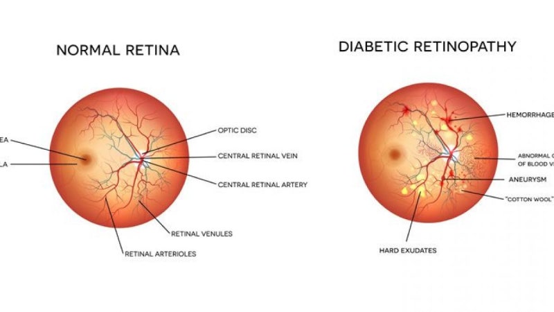 당뇨망막병증(Diabetic Retinopathy)