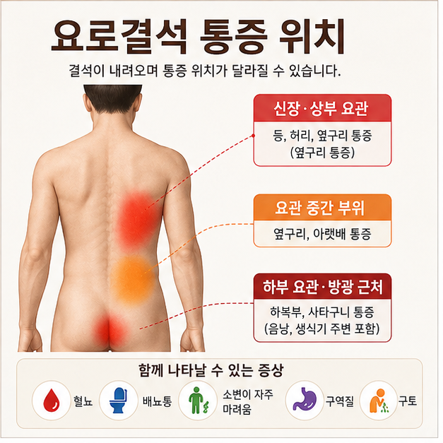 요로결석 증상, 원인, 통증, 자연배출, 수술, 치료, 핵심정리
