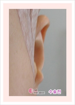누운귀 교정 필러없이 수술로 가능할까요?무보형물로 누운귀 성형 개선하는 방법