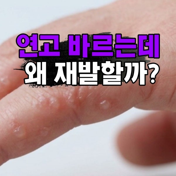 손가락 한포진 연고를 몇통째 써도 계속 재발한다면?