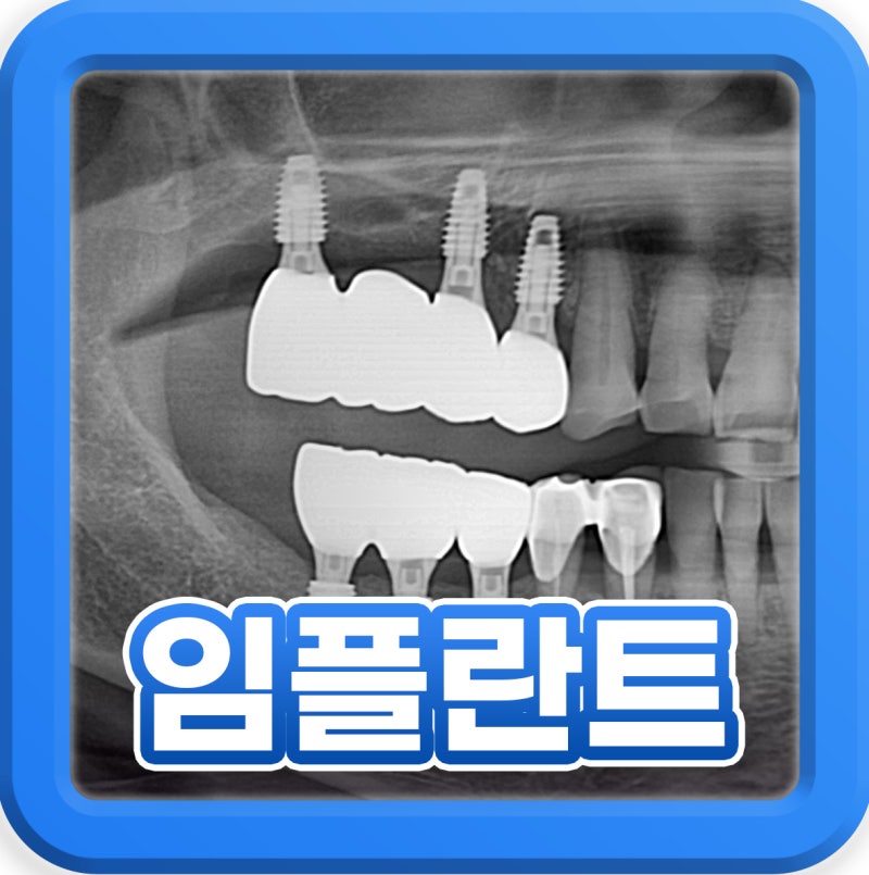 영도임플란트 후 식사 언제부터? 당일 피해야 할 음식