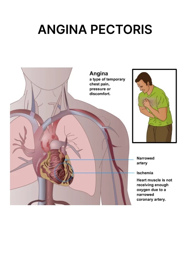 협심증 Angina Pectoris: 가슴이 조여 왔던 10분, 인류는 250년을 걸려 그 이유를 알았습니다