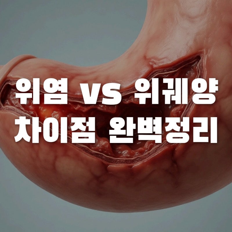 위염위궤양차이 모르면 손해? 헬리코박터제균치료와 위점막보호 꿀팁