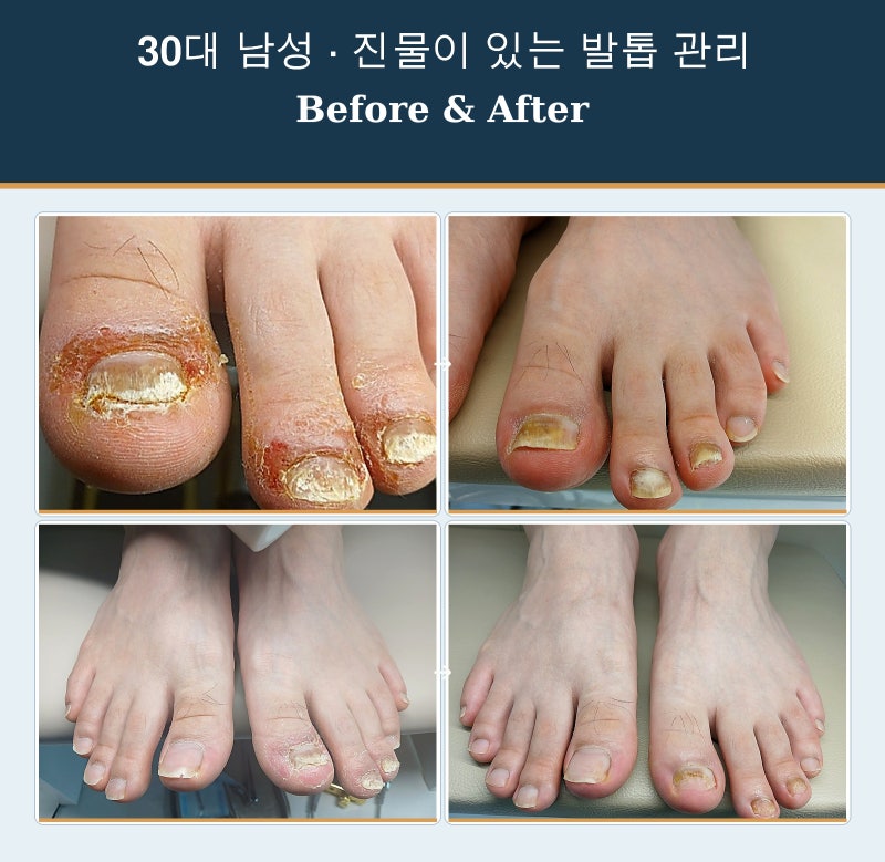 인천지간무좀 치료도 중요하답니다
