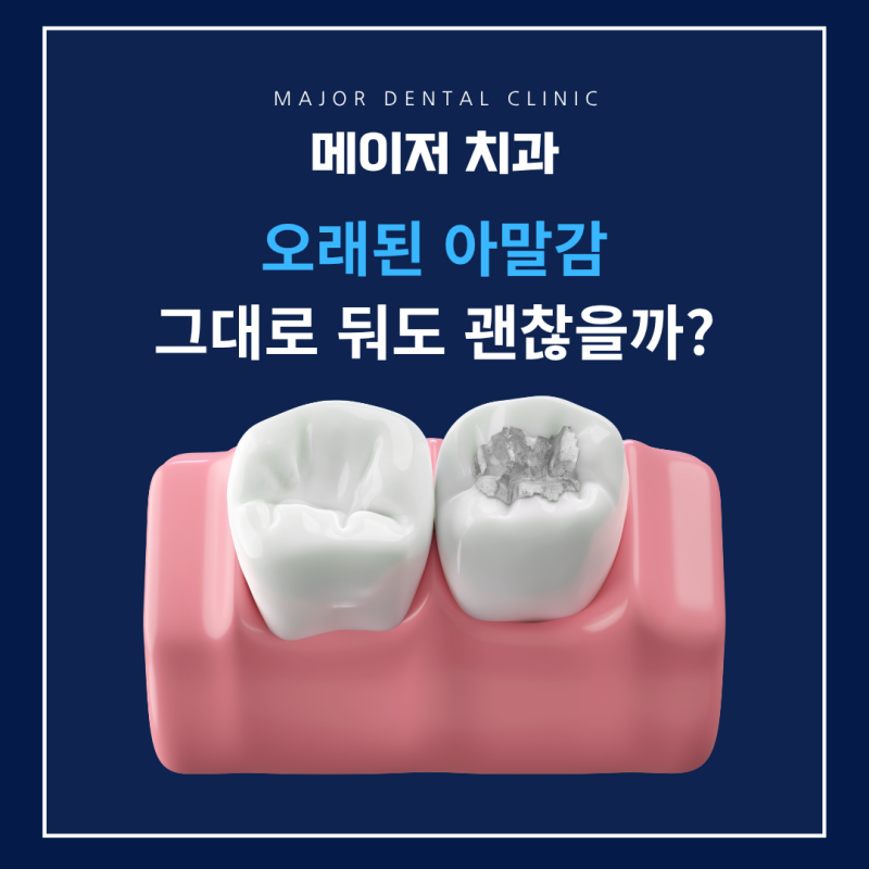 각산역치과 오래된 아말감 교체를 해야할까요