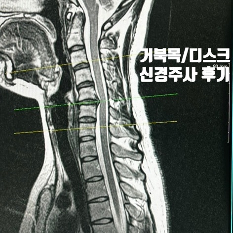 목디스크 진단 2년 경과 병원 재방문... 신경차단술 비용 아픔 찐 후기