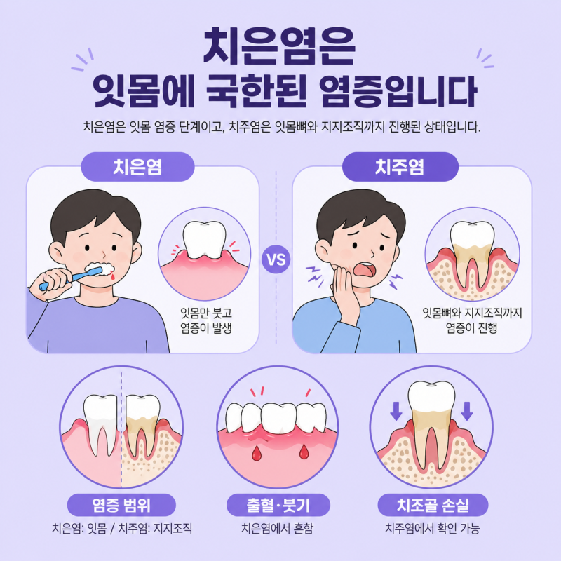 치은염 치주염 증상 차이 내 잇몸병은 지금 어떤 단계일까?