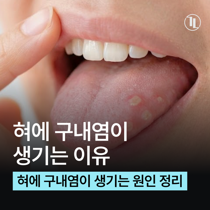 혀에 자꾸 구내염이 생긴다면? 원인부터 치료 관리법까지 / 강남레옹치과