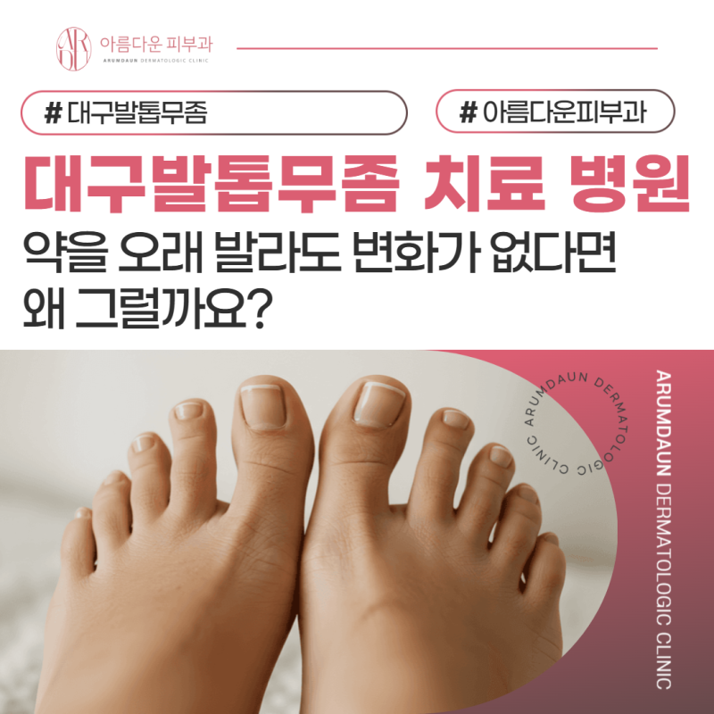 대구발톱무좀 치료 병원 약을 오래 발라도 변화가 없다면 왜 그럴까요?