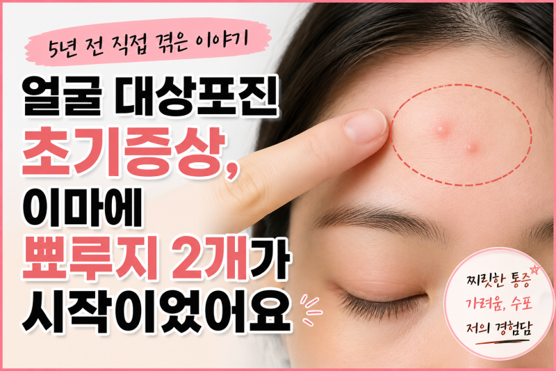얼굴 대상포진 초기증상, 이마 수포보다 먼저 왔던 이상한 통증
