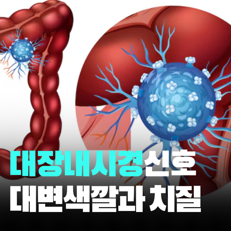 대장암 초기증상 변 색깔 구분과 대장내시경 기준