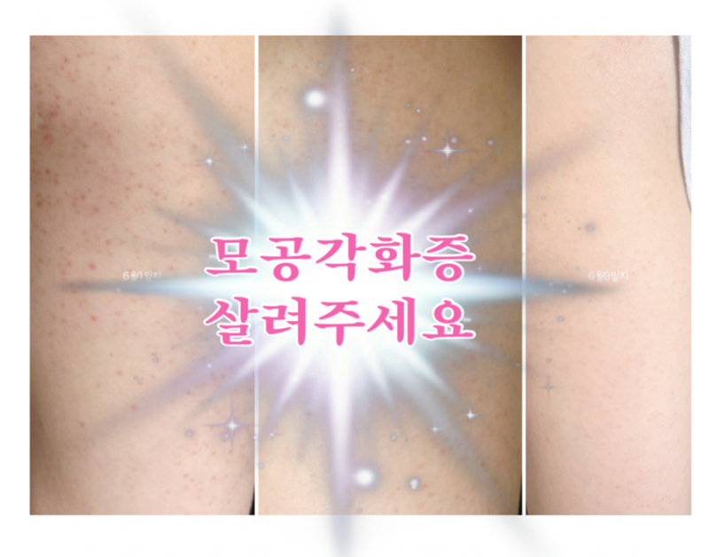 (광고아님X) 모공각화증 찐 후기, 이제야 효과 본 바디로션 추천 (+ 전후사진, 제품추천)