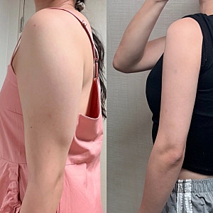 대구 팔 지방흡입 3개월차 팔뚝살 다이어트 성공! 인생 대 만족 후기 (+멍붓기 수술후관리, 라....