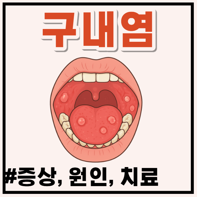 입안 헐었을때 혓바늘 통증, 아프타성 구내염 빨리 낫는법