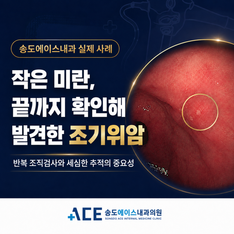 송도 위내시경, 위염처럼 보인 작은 미란을 끝까지 확인해 발견한 조기위암