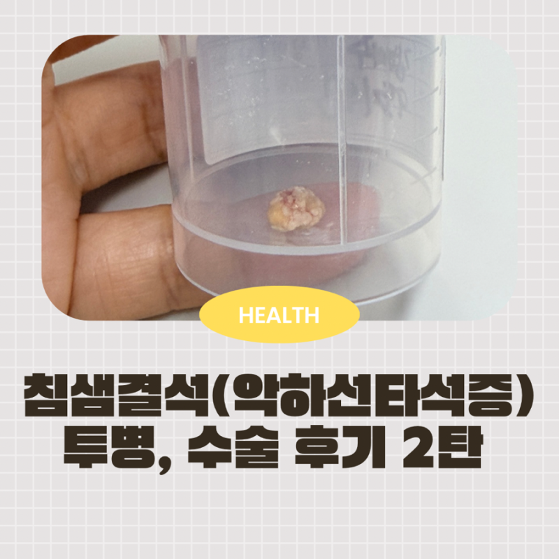 땡큐서울의원 악하선 타석증 침샘결석 수술 후기