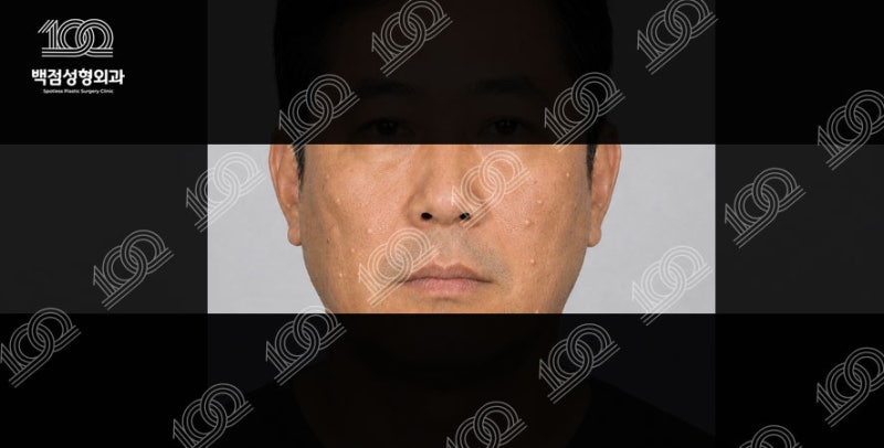 피지낭종 여러개 한번에 제거 될까? 다발성피지낭종