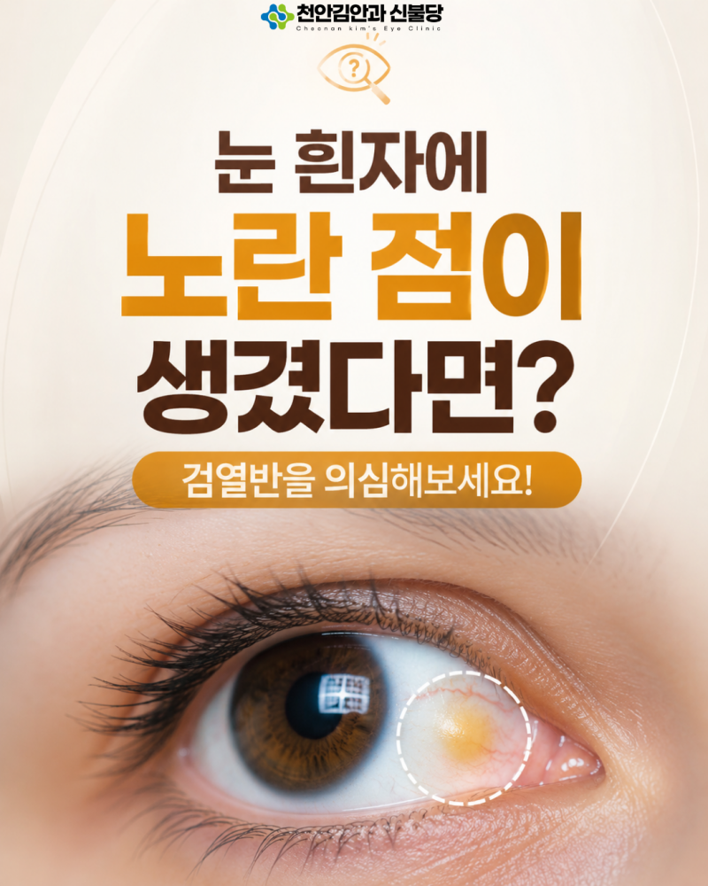 눈 흰자에 노란 점이 생겼다면? 검열반을 의심해보세요!