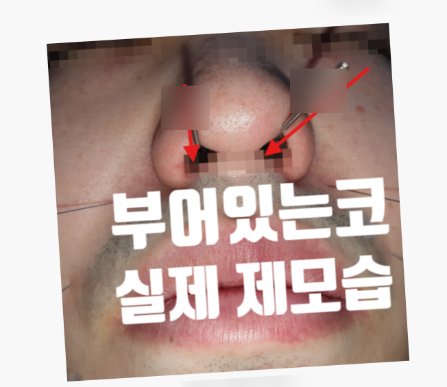 비염이 심해지면 왜 귀까지 먹먹할까요? 코와 귀를 연결하는 이관기능장애