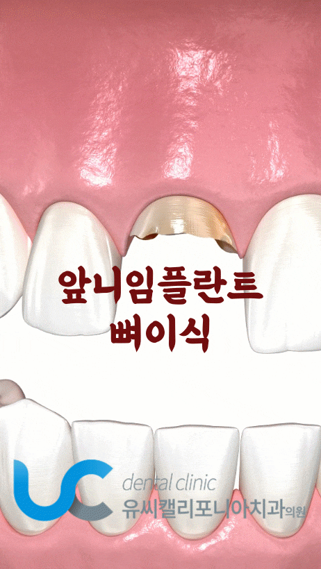 앞니임플란트 잇몸염증 뼈부족시 임플란트뼈이식 방법에 관한 이야기