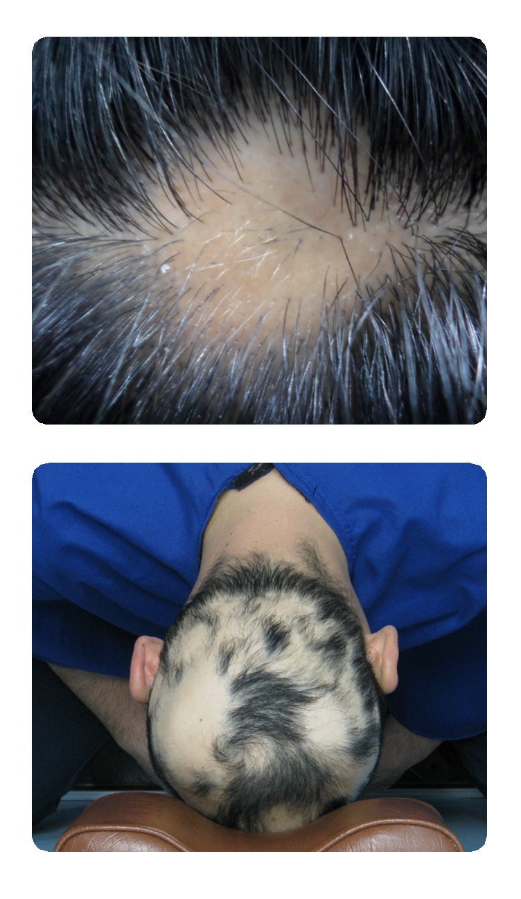 갑자기 찾아온 원형탈모, 풀잎한의원 맞춤 한방 치료로 해결하세요!｜대전 유성구 상대동 봉....