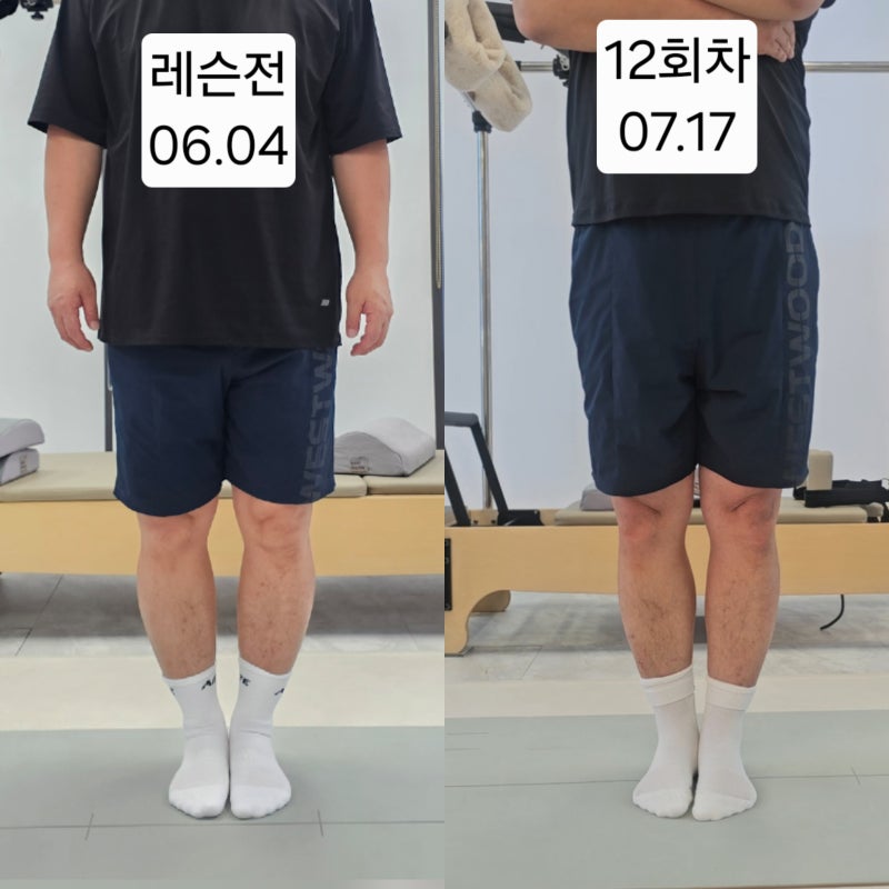 오다리 교정 깔창 효과 있나요? 오다리 교정12회만에 해결하기(실제사례와 함께 )