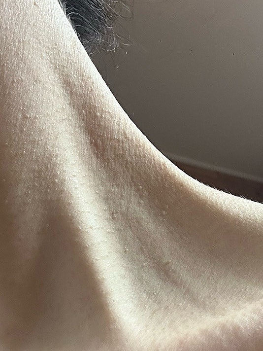편평사마귀 무제한 제거 받아봤어요｜병원 선택부터 가격·통증·경과까지