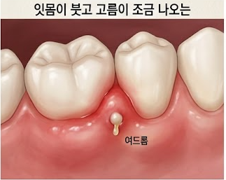 잇몸에 여드름처럼 볼록? 고름·치통 있는데 치과 못 갈 때 응급 대처법