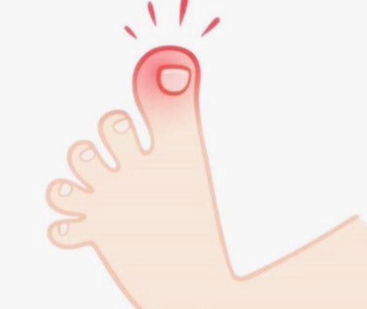 "엄지발가락에서 고름이 나온다면? 내성발톱과 세균감염을 구별하는 신호"