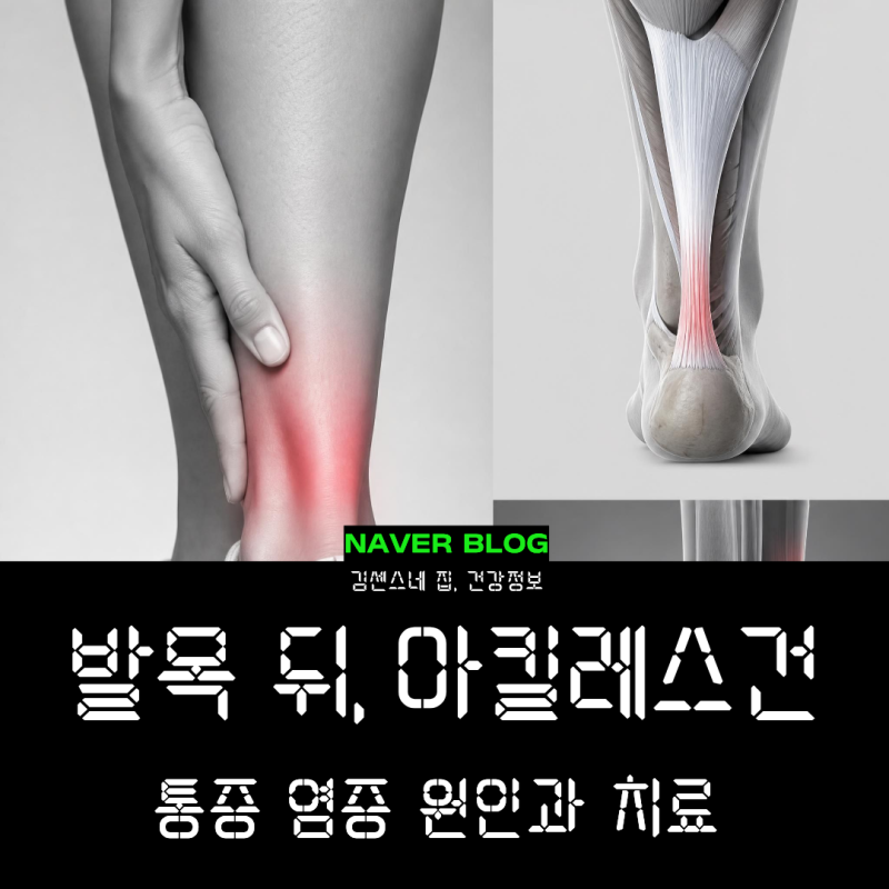 발목 뒤쪽 아킬레스건 통증, 아킬레스건염 증상 원인과 치료