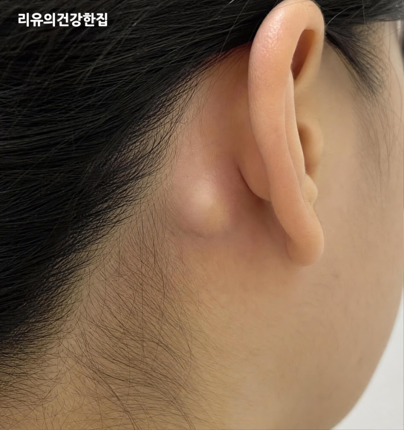 귀뒤 멍울 통증, 의심해봐야할 피지낭종 증상, 치료