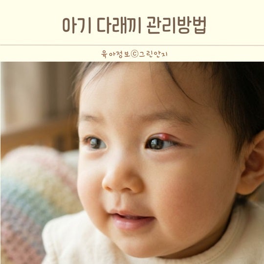 영유아 아기 어린이 눈다래끼 눈이 붓고 빨갛다면? 증상과 관리방법