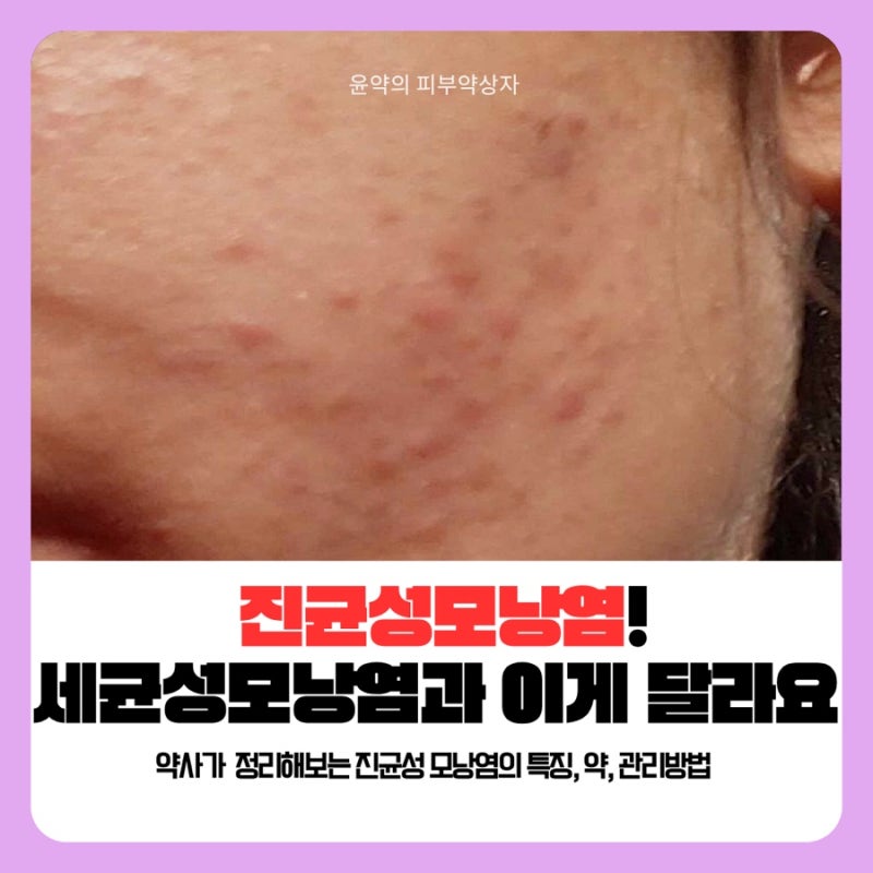 진균성모낭염 (말라세지아모낭염) vs 세균성모낭염, 약사가 짚어보는 특징과 약 그리고 관리....
