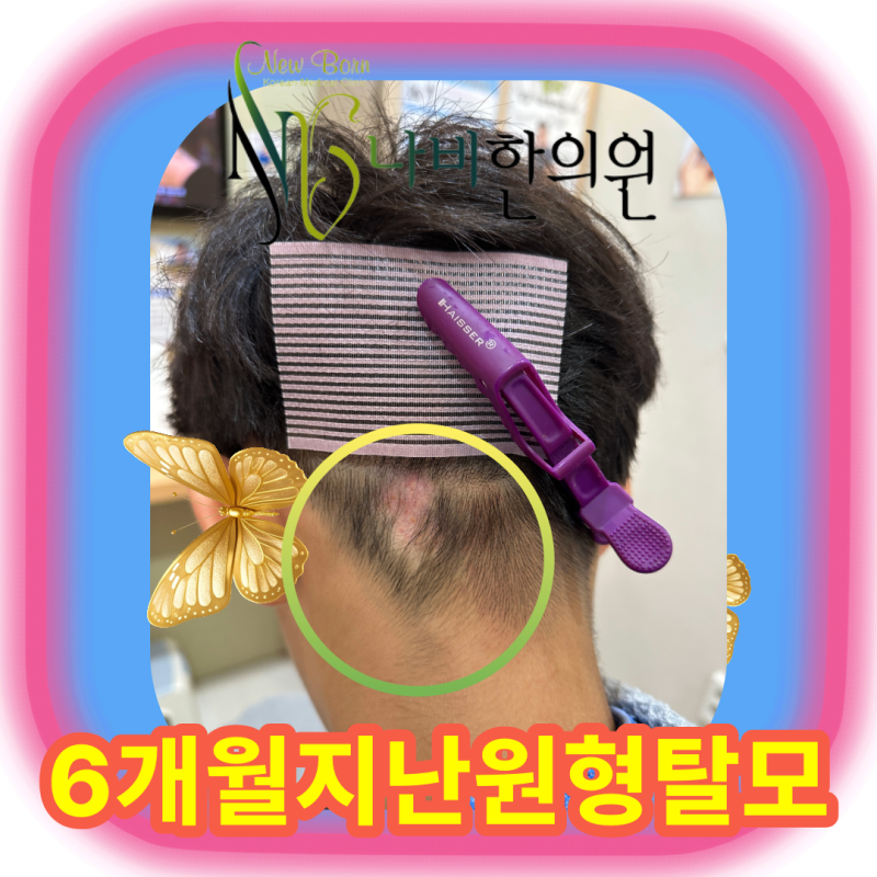 부산 어린이 원형탈모, 주사치료를 몇 달 받아도 그대로라면