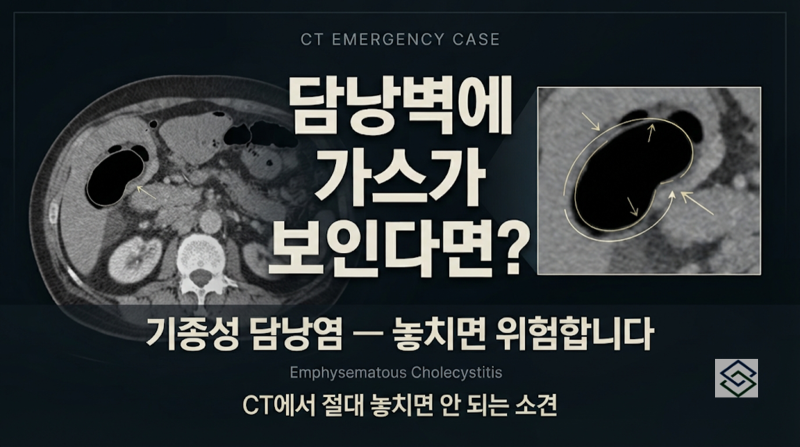 Case Study_1051-우측 상복부 통증을 호소하는 76세 남성-기종성 담낭염(Emphysematous cholecystitis)