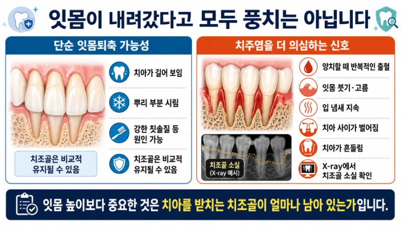 잇몸이 내려앉아 치아가 길어 보인다면? 풍치 진행 신호와 치조골을 지키는 방법
