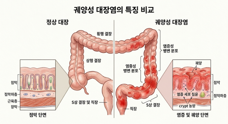 궤양성대장염이란?｜증상부터 원인, 치료까지 쉽게 알아보기