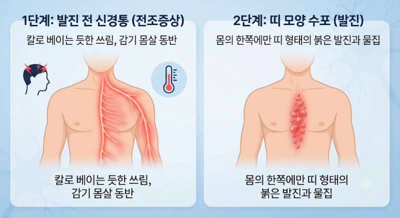 대상포진 초기증상과 전염성 총정리: 허리·허벅지·손 통증 부위별 특징, 전염 경로 및 골든....